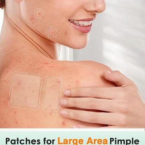 166-Piece Pimple Patch Set