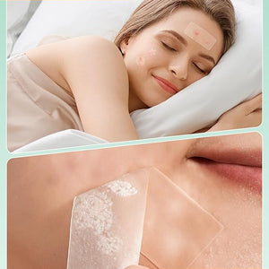 166-Piece Pimple Patch Set